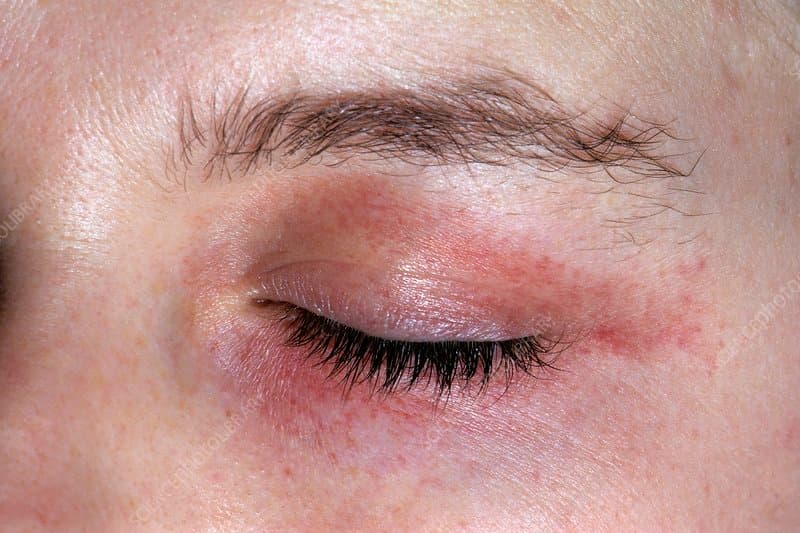 الداء النشواني الجلدي: الأسباب والأعراض والتشخيص والعلاج