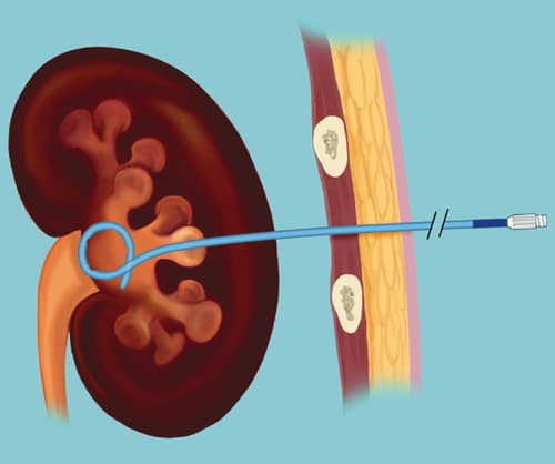 انسداد الحالب: الأسباب والأعراض والتشخيص والعلاج