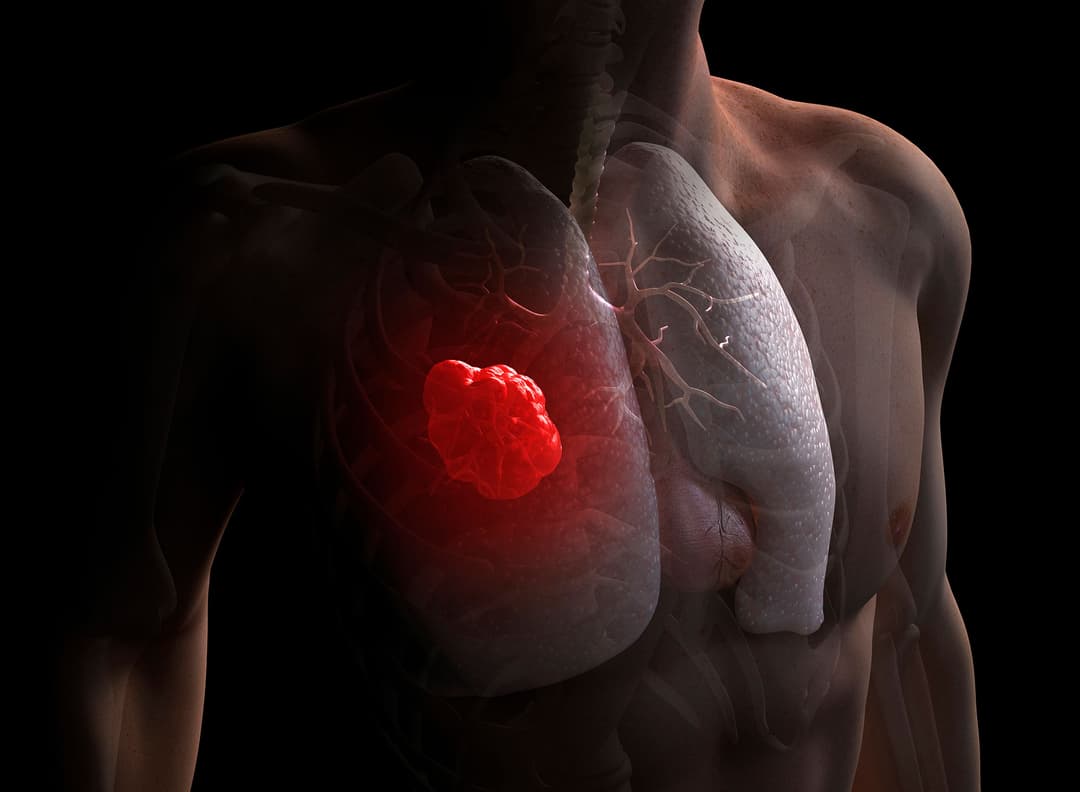 عضو لطالما اعتبره الأطباء عديم الجدوى قد يكون سلاحنا لمحاربة السرطان