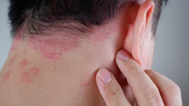علاج الالتهاب المزمن المترافق مع الصدفية