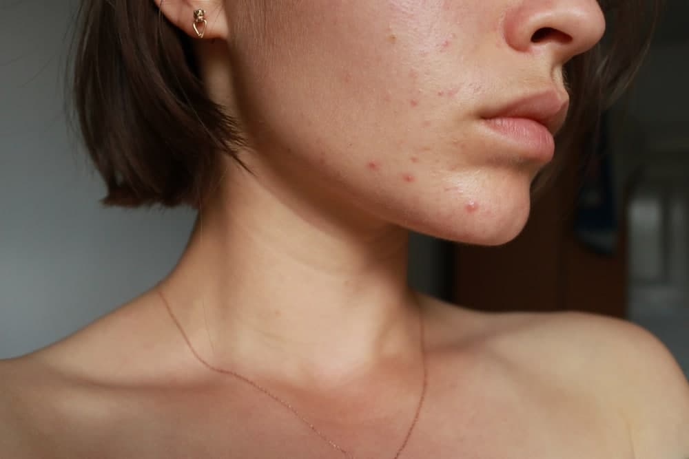 حب الشباب: ما أسبابه وكيفية علاجه؟