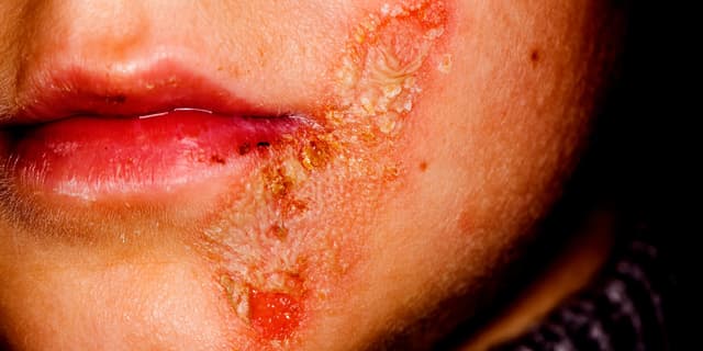 متلازمة ستيفنز جونسون