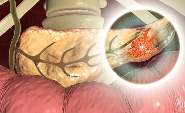 سرطان البنكرياس: طرق العلاج