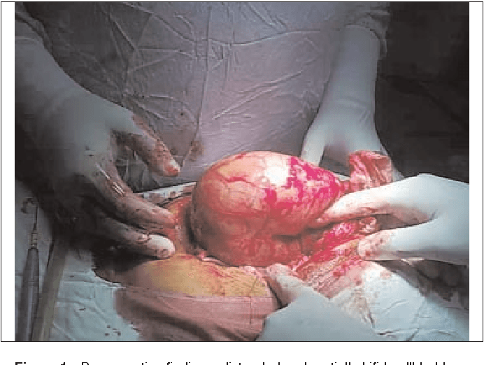 علامة كورفوازيه: الأعراض والأسباب والتشخيص والعلاج