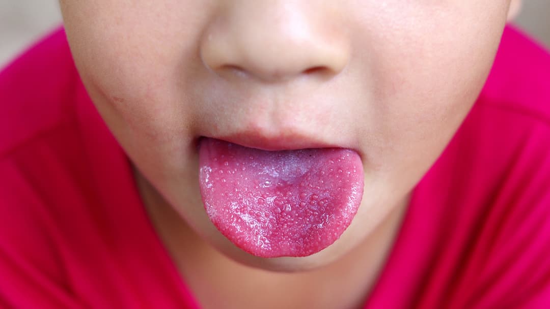 الحمى القرمزية: الأعراض والعلاج