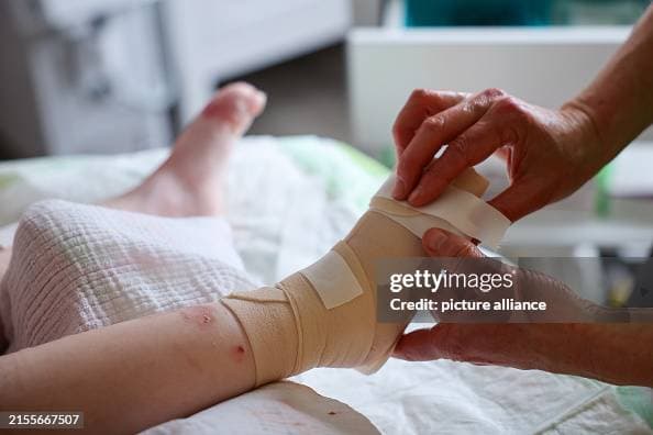 مرض الفراشة: اضطراب يجعل الجلد رقيقًا مثل أجنحة الفراشة!