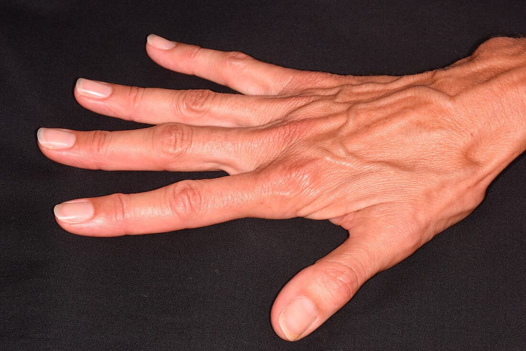 متلازمة مارفان: الأسباب والأعراض والتشخيص والعلاج