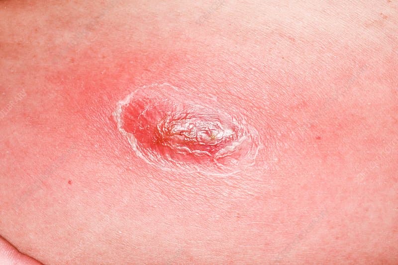 الخراج البطني: الأسباب والعلاج