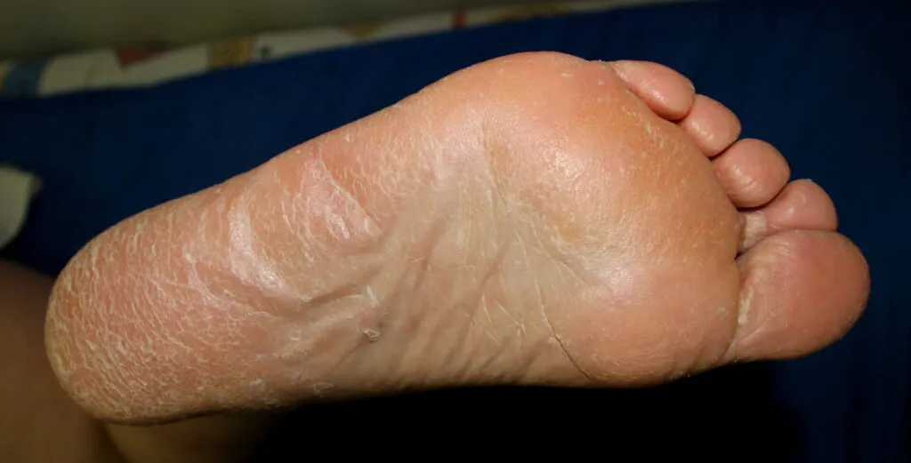 تقرن جلد الراحة والأخمص: الأسباب والأعراض والتشخيص والعلاج