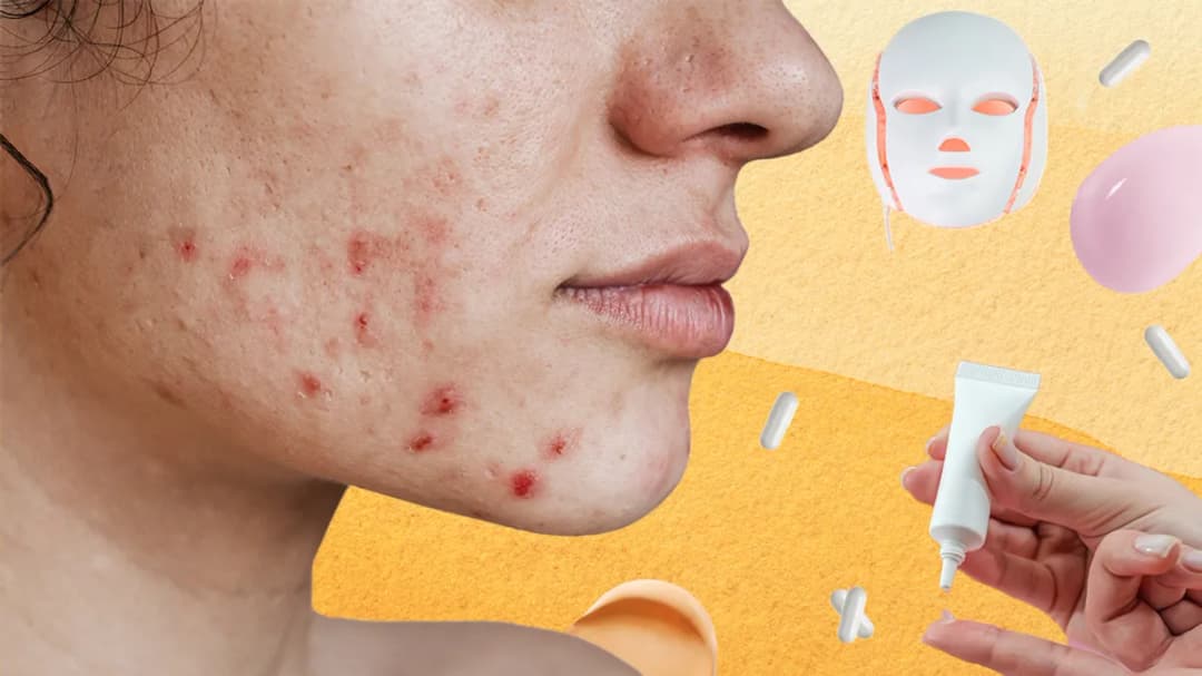 الريتينويدات والبروبيوتيك والعلاج بالضوء المرئي: الجديد في علاج حب الشباب