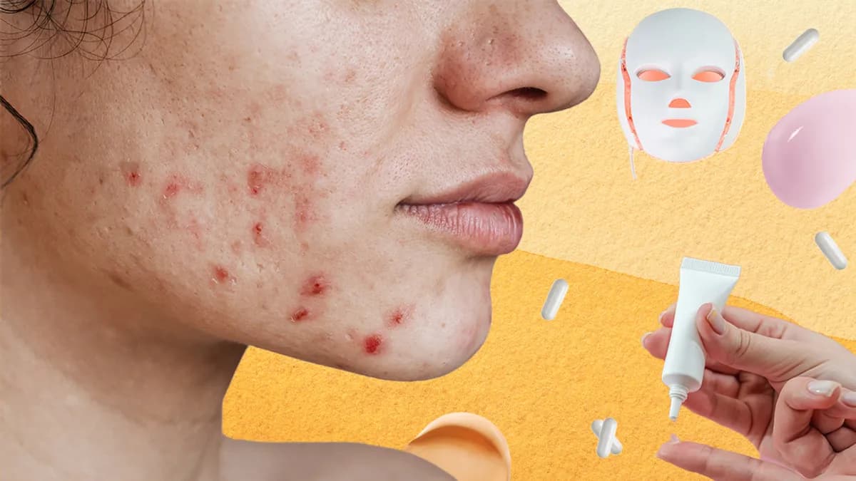 الريتينويدات والبروبيوتيك والعلاج بالضوء المرئي: الجديد في علاج حب الشباب