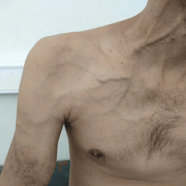 متلازمة باجيت-شروتر: الأسباب والعلاج