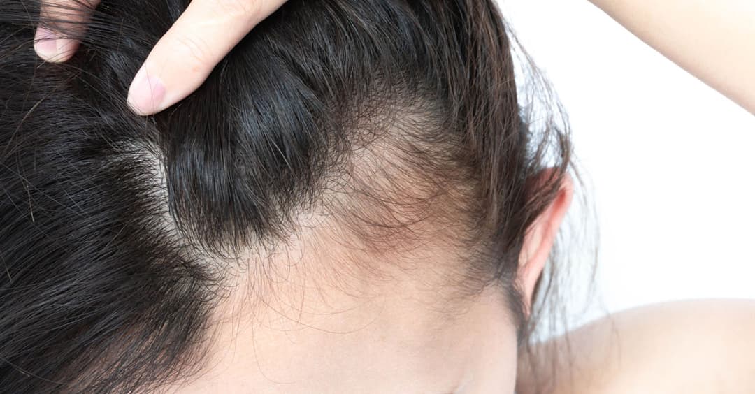 الجينات، الهرمونات وتصفيف الشعر: إليك بعض أسباب تساقط الشعر التي ربما لم تسمع بها من قبل