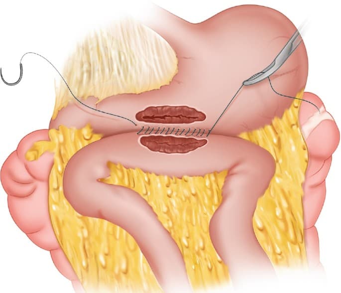 المفاغرة المعدية الصائمية: نظرة شاملة على جراحة تحويل مسار الجهاز الهضمي