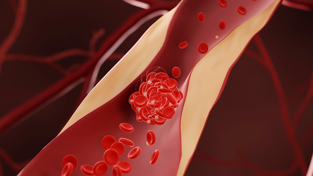 الأدوية التي تخفّض الكوليسترول قد تقلّل أيضًا من خطر الإصابة بالخرف