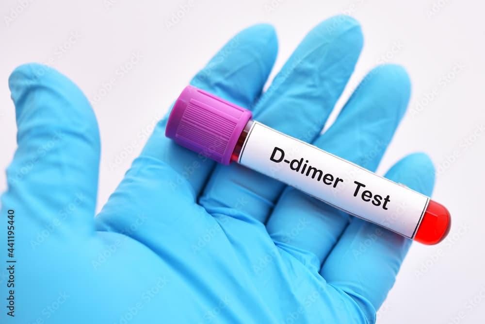 اختبار د-دايمر: تعريفه ودواعي الإجراء
