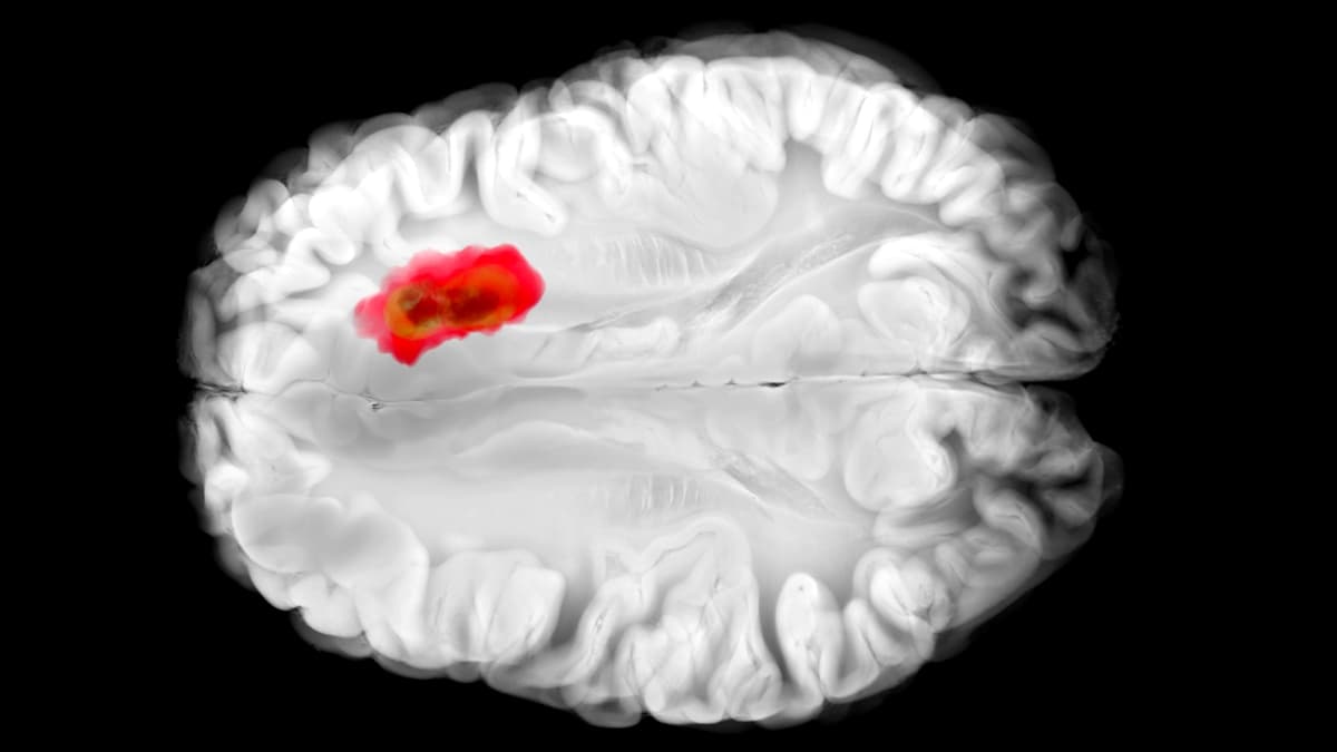يبدو أن هذا الدواء الشائع يحارب أحد أخطر أنواع سرطان الدماغ