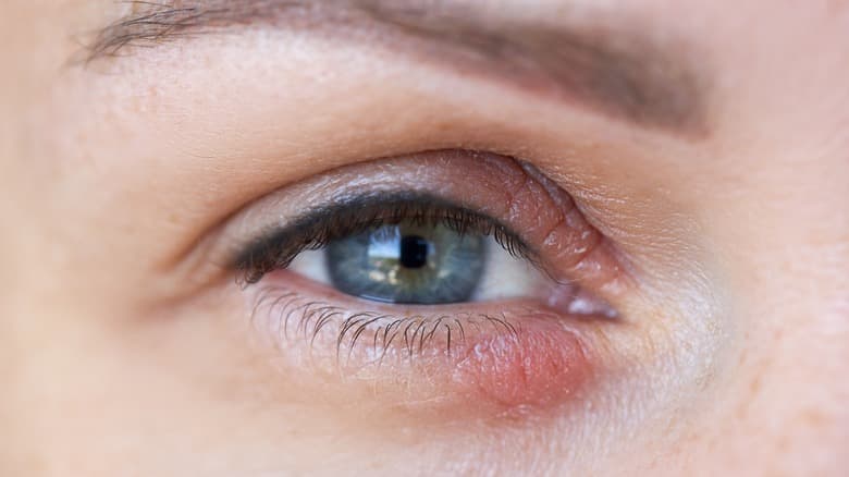 كيفية التعامل مع جفاف الجلد تحت العينين