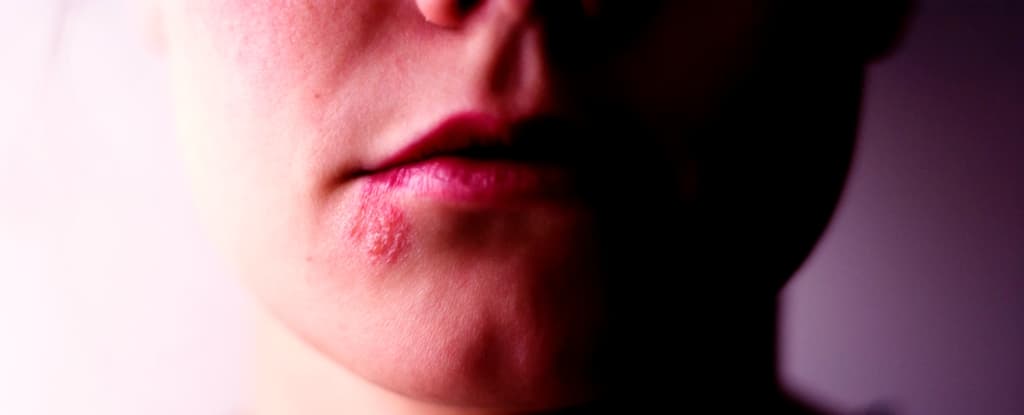 فيروس الهربس ومرض ألزهايمر، هل هي علاقة مرض ومُمرض!