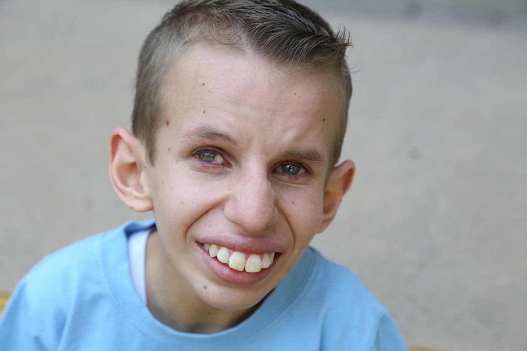 ما هي متلازمة كوكاين؟ الأعراض والتشخيص والعلاج