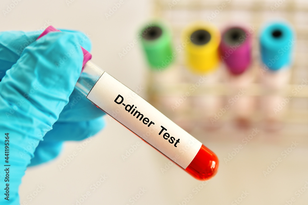 اختبار دي دايمر (تحليل D-dimer): دواعي إجراء التحليل والتفاصيل وتفسير النتائج