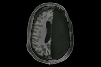 دراسة تُظهر كيف يعيش بعض الأشخاص ممن فقدوا نصف دماغهم إزالة أحد نصفي الكرة المخية لمعالجة نوع شديد ونادر من داء الصرع فقدان نصف الدماغ