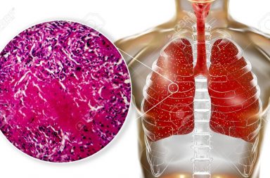 السل الدخني: الأسباب والأعراض والتشخيص والعلاج - إنتان خطير يصيب الرئتين فقط - المتفطرات السلية Mycobacterium tuberculosis