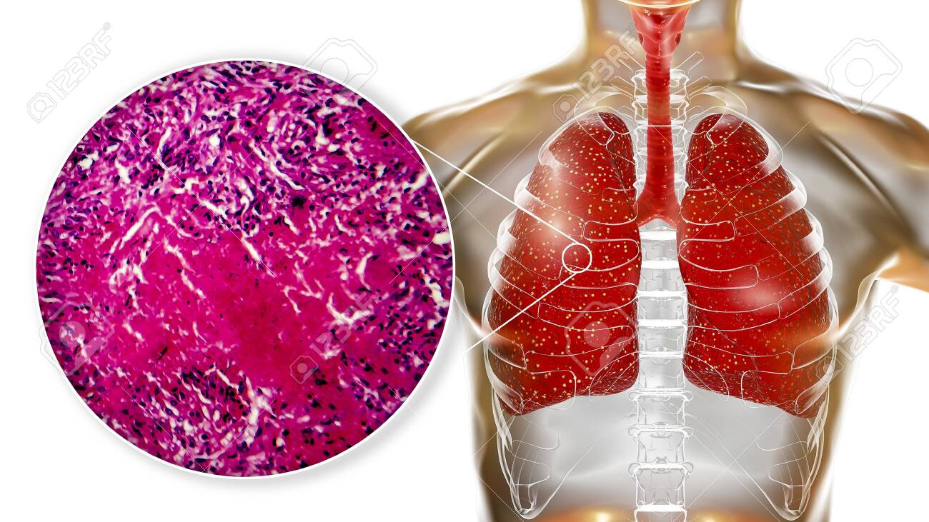 السل الدخني: الأسباب والأعراض والتشخيص والعلاج