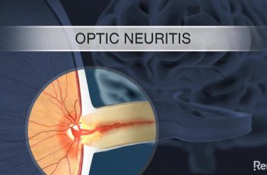 التهاب العصب البصري Optic neuritis الأسباب والأعراض والتشخيص والعلاج التصوير المقطعي البصري التهاب النخاع والعصب البصري التصلب المتعدد