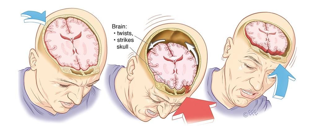 ما هو ارتجاج الدماغ؟ وما هي أعراضه وكيفية الإصابة به؟