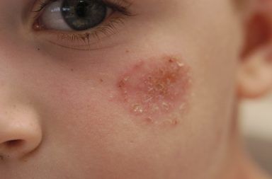 القوباء التهاب جلدي معدٍ بشدة يصيب الأطفال المكورات العنقودية التهاب في الجلد آفات جلدية فقاعات متوسطة إلى كبيرة ومملوءة بالسائل