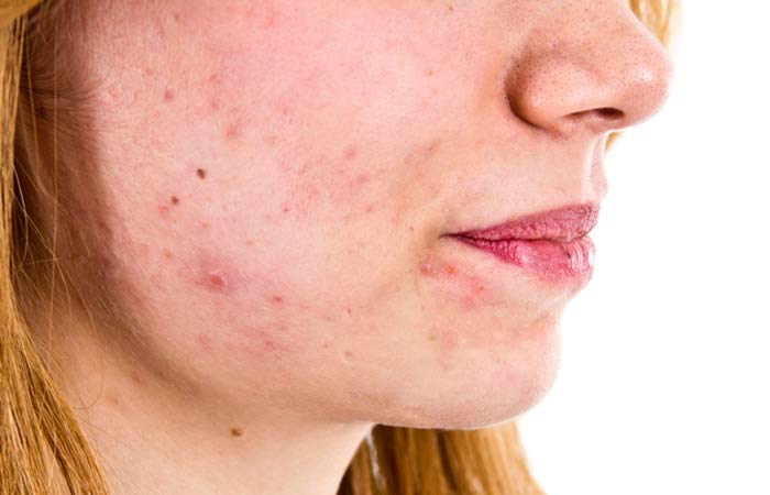 بقع الوجه والبقع الداكنة على الجلد: الأسباب وكيفية علاجها