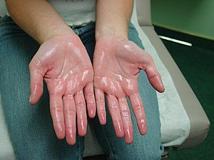 Hyperhidrosis disorder (excessive sweating): causes and treatment - condition that leads to excessive sweating - physical activity and tension - adrenal disorders