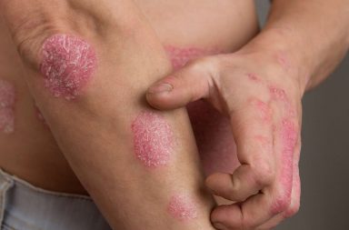 الصدفية - مرض مناعي مزمن يسبب تراكم خلايا الجلد ما يؤدي لتدرجات على سطح الجلد - رقع حمراء سميكة - مهاجمة البكتيريا ومحاربة العدوى