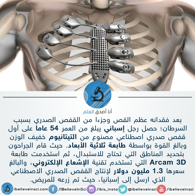 أول قفص صدري اصطناعي مصنوع من التيتانيوم بواسطة طابعة ثلاثية الأبعاد