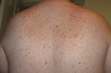 الشرى الصباغي Urticaria pigmentosa: الأسباب والأعراض والتشخيص والعلاج - النمط الأكثر شيوعًا من كثرة الخلايا البدينة في الجلد