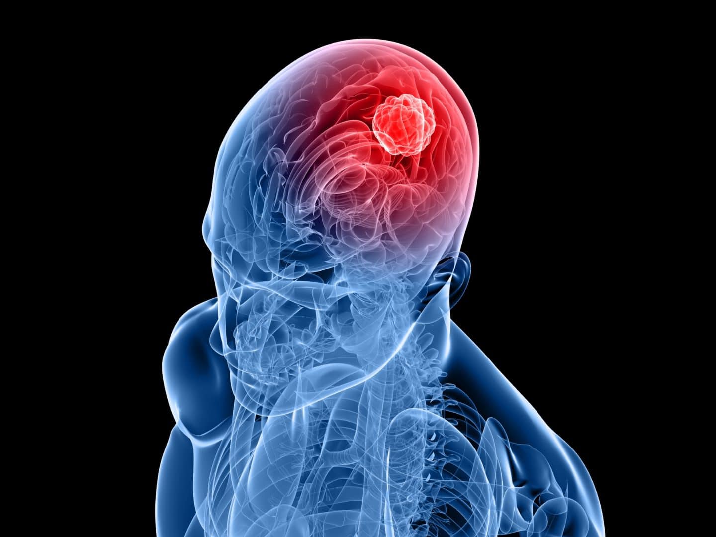 خلايا جذعية محملة بفيروس الهيربس يمكنها القضاء على أورام الدماغ