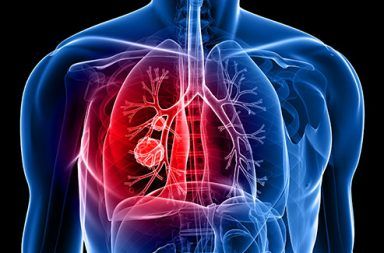 سرطان الرئة lung cancer: الأسباب والأعراض والتشخيص والعلاج أخطر وأشيع أنواع السرطانات السعال المتكرر ضيق في التنفس السعال الدموي