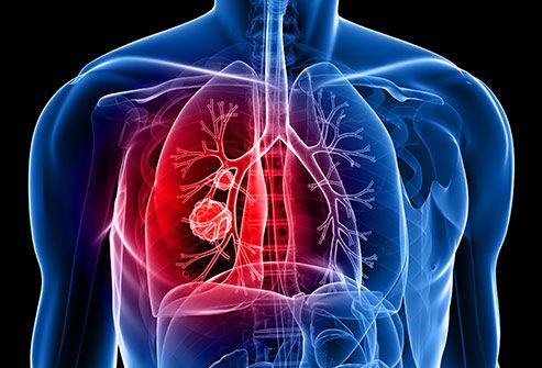 سرطان الرئة lung cancer: الأسباب والأعراض والتشخيص والعلاج