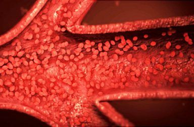 كثرة الحمر الحقيقية: الأسباب والأعراض والتشخيص والعلاج نوع نادر من سرطان الدم يزداد فيه إنتاج الجسم من خلايا الدم الحمراء