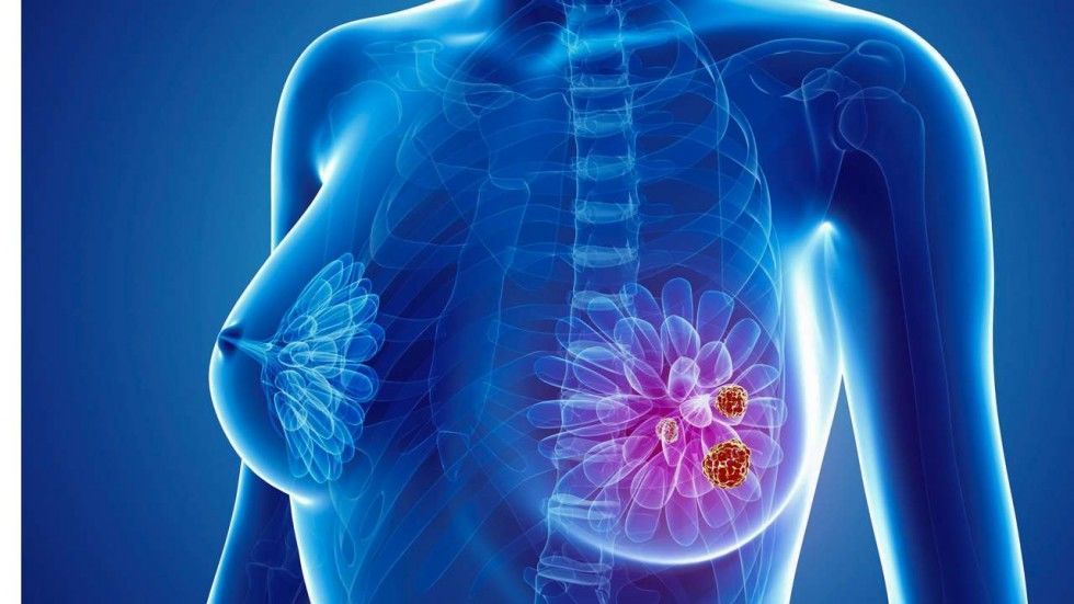 هل ينتهي خطر سرطان الثدي مع انتهاء العلاج؟