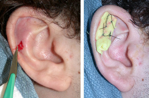 تصريف الورم الدموي الأذني: تفاصيل الإجراء والمضاعفات