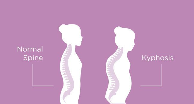 الحداب Kyphosis اسبابه ، علاجه و سبل الوقاية منه