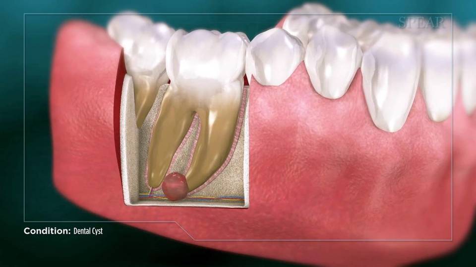 الأكياس السنية: الأسباب والأعراض والتشخيص والعلاج