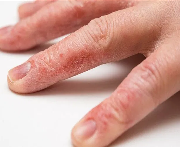 ما أسباب تقشر جلد اليدين وما علاجه؟ أنا أؤمن بالعلم