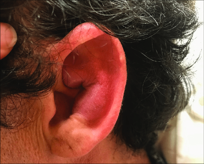 الورم الدموي الأذني: الأسباب والأعراض والتشخيص والعلاج