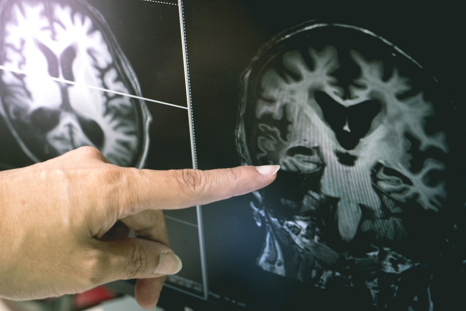 المتلازمة الدماغية العضوية: الأسباب والأعراض والتشخيص والعلاج
