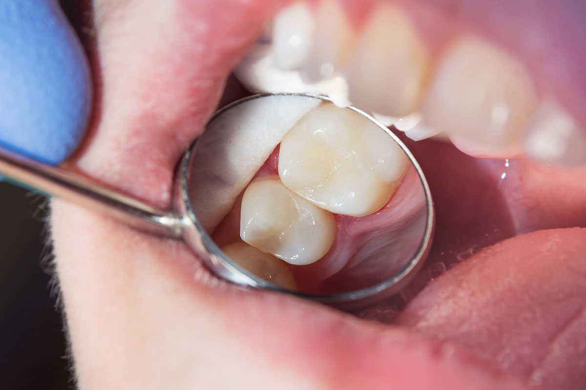 هل حشوات الأسنان مؤلمة؟