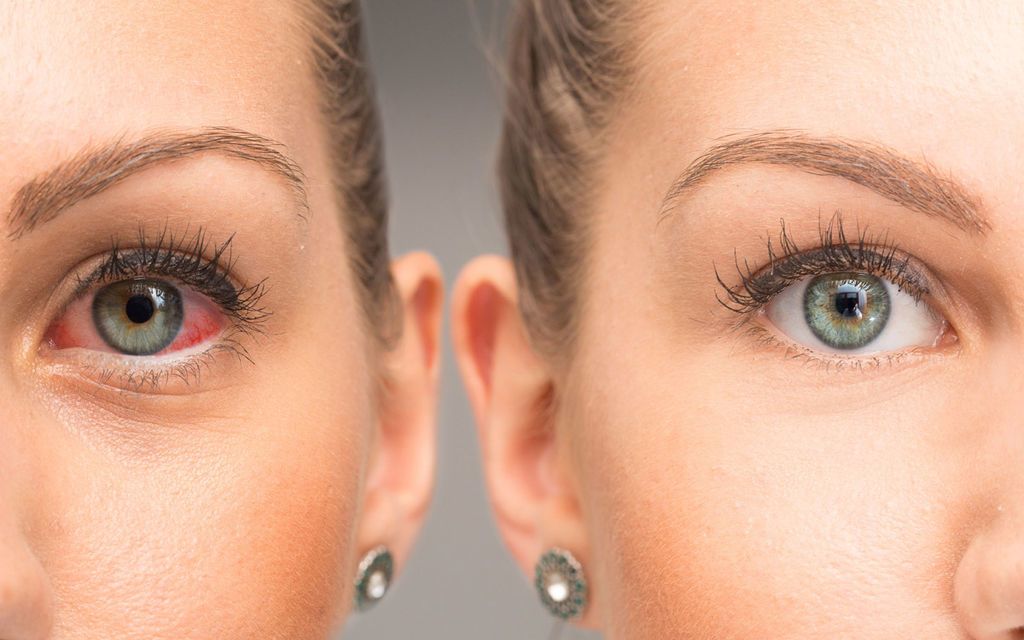 التهاب الملتحمة أو العين الوردية: الأعراض والأسباب والعلاج والتشخيص
