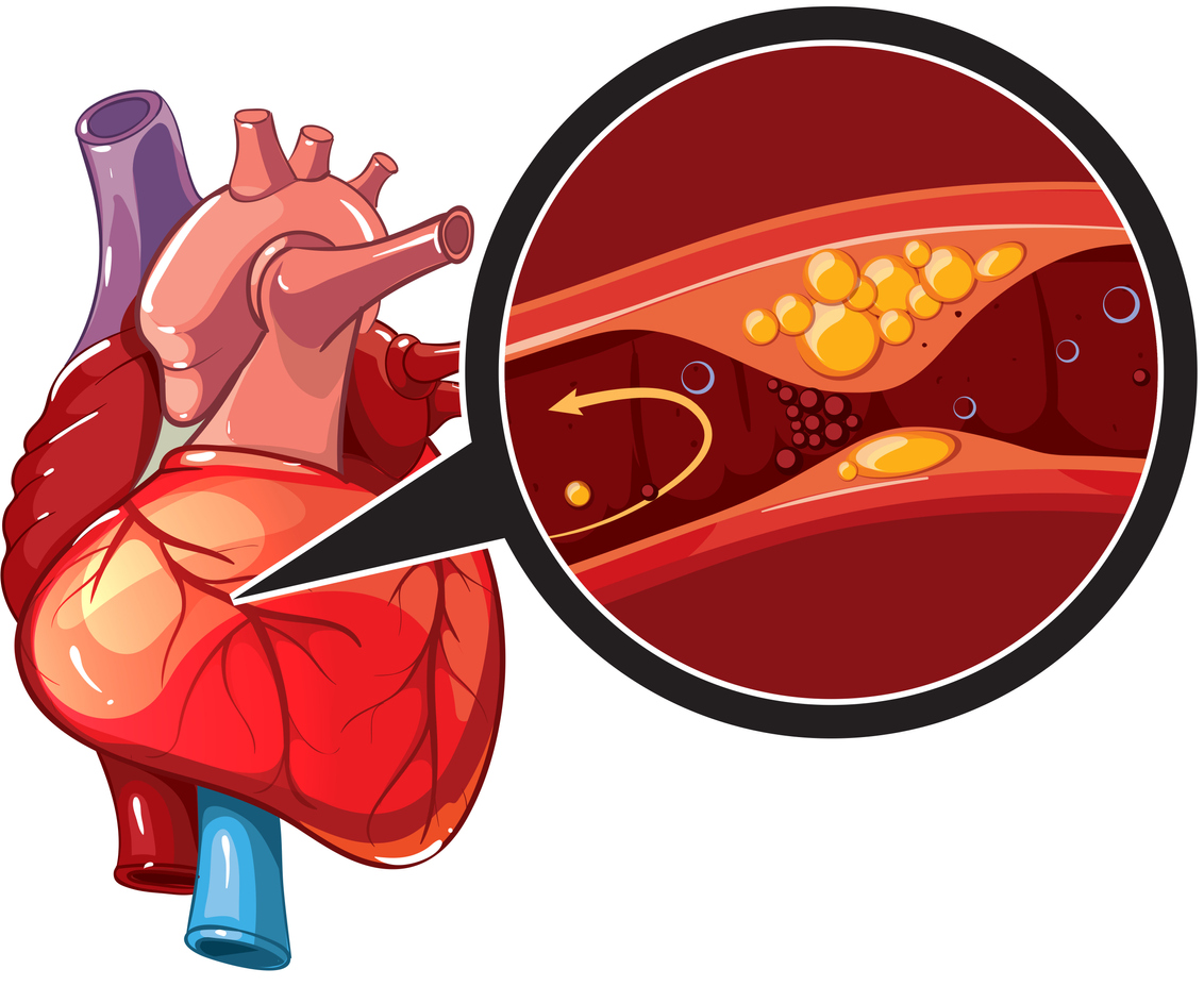 الداء القلبي الإكليلي متعدد الأوعية: الأسباب والأعراض والتشخيص والعلاج